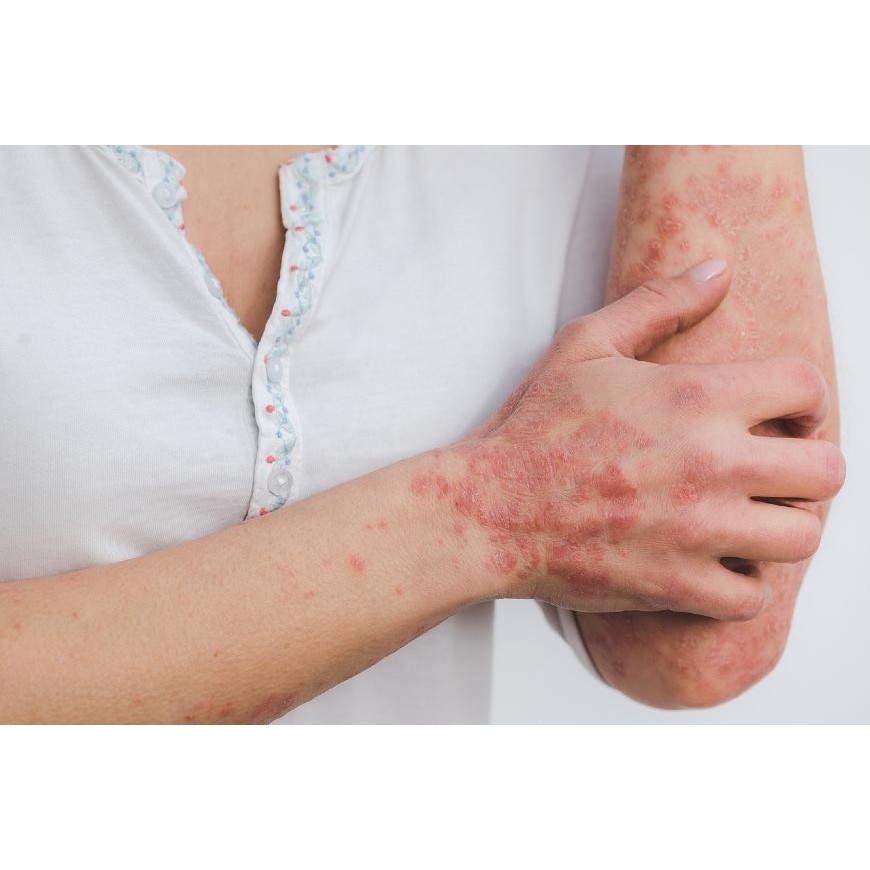 CBD und Psoriasis – wie wirksam ist es?